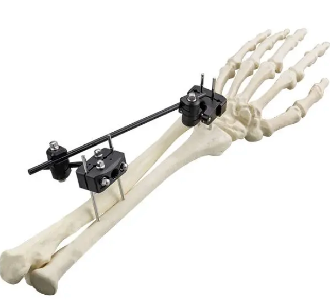 Φ5.0 Series External Fixation Fixator – Distal Radius Frame