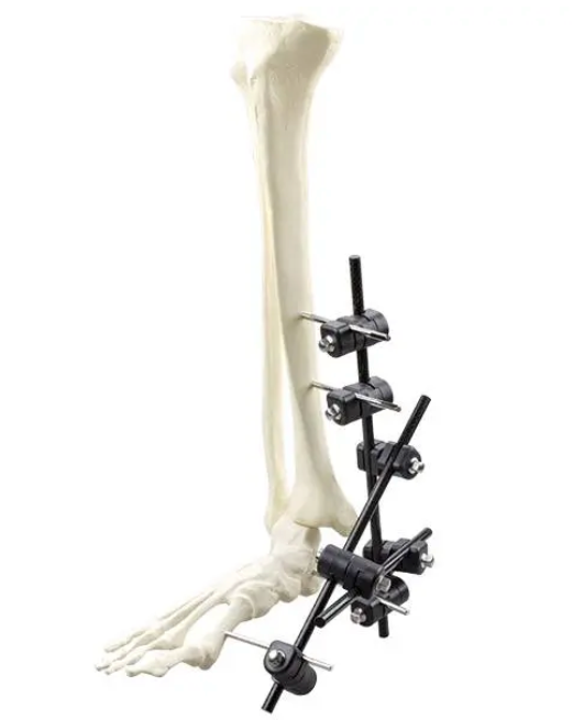 Φ8.0 Series External Fixation Fixator – Ankle Stabilization Frame