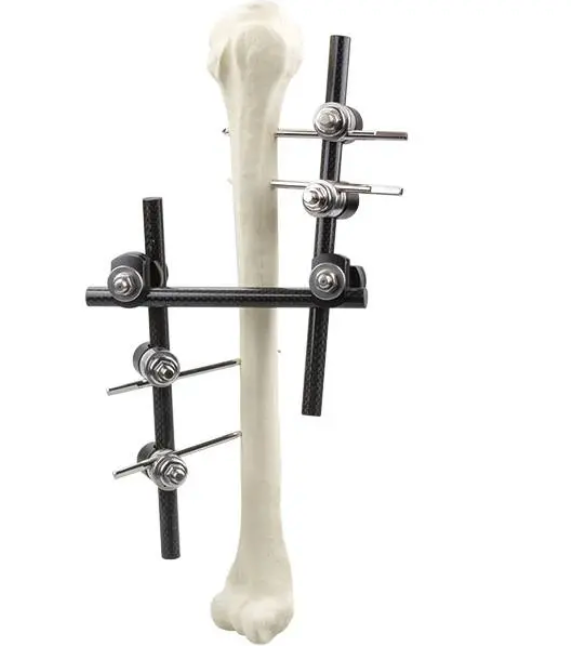 Φ11.0 Series External Fixation Fixator – Humerus Backbone Frame