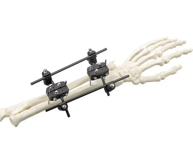 Φ5.0 Series External Fixation Fixator – Radius Backbone Frame