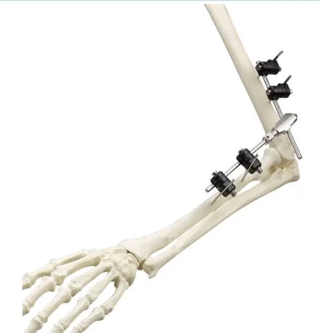 Φ5.0 Series External Fixation Fixator – Children’s Elbow Joint Frame