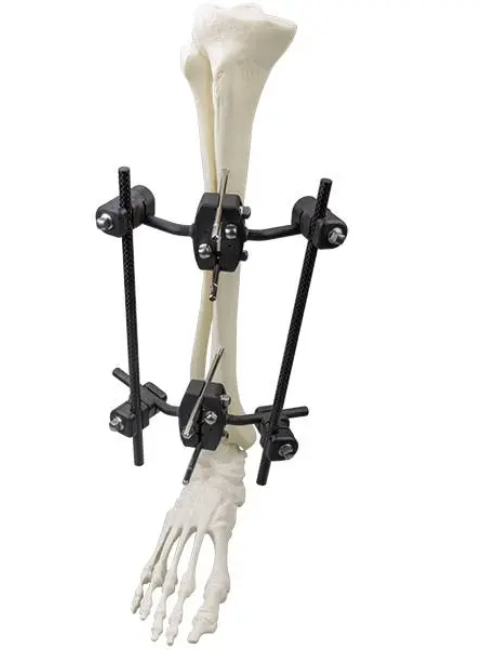 Φ8.0 Series External Fixation Fixator – Tibiaaxis Unilateral Frame