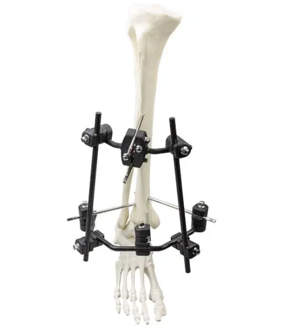 Φ8.0 Series External Fixation Fixator – Distal Tibia Semicircular Frame