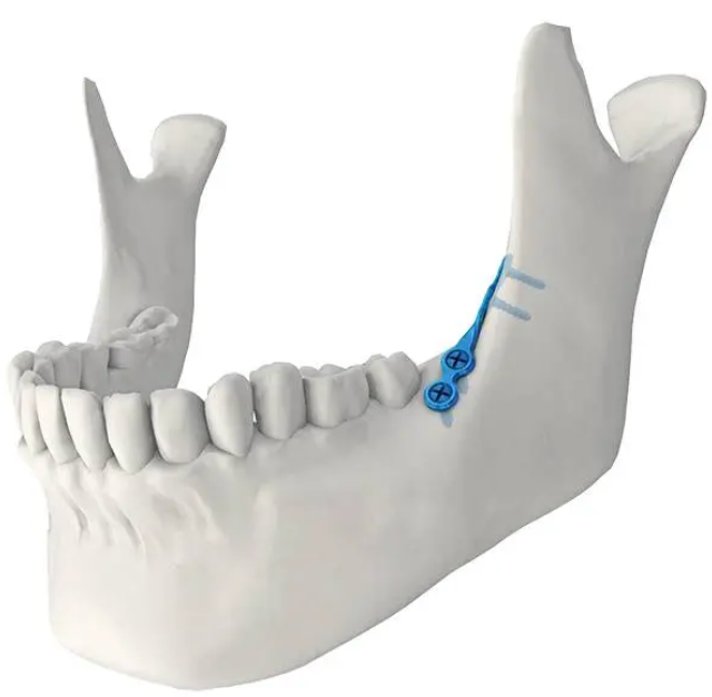 Placa de ponte reta maxilofacial com bloqueio anatômico