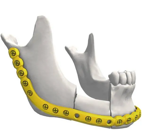 Locking Reconstruction Anatomical 120° Plate (One Hole Select Two Kinds Of Screw)