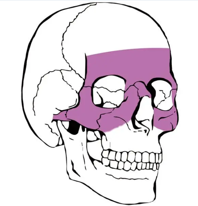 Placa retangular micro para trauma maxilofacial