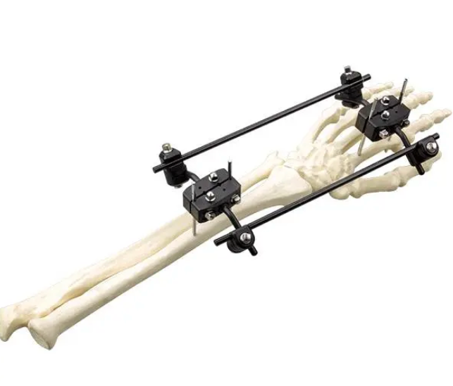 Φ5.0 Series External Fixation Fixator – Radius Cross-Articular Frame ...