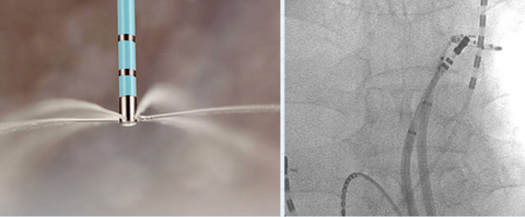 Irrigated Ablation Catheter