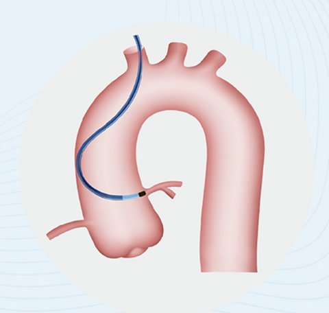 March Guiding Catheter